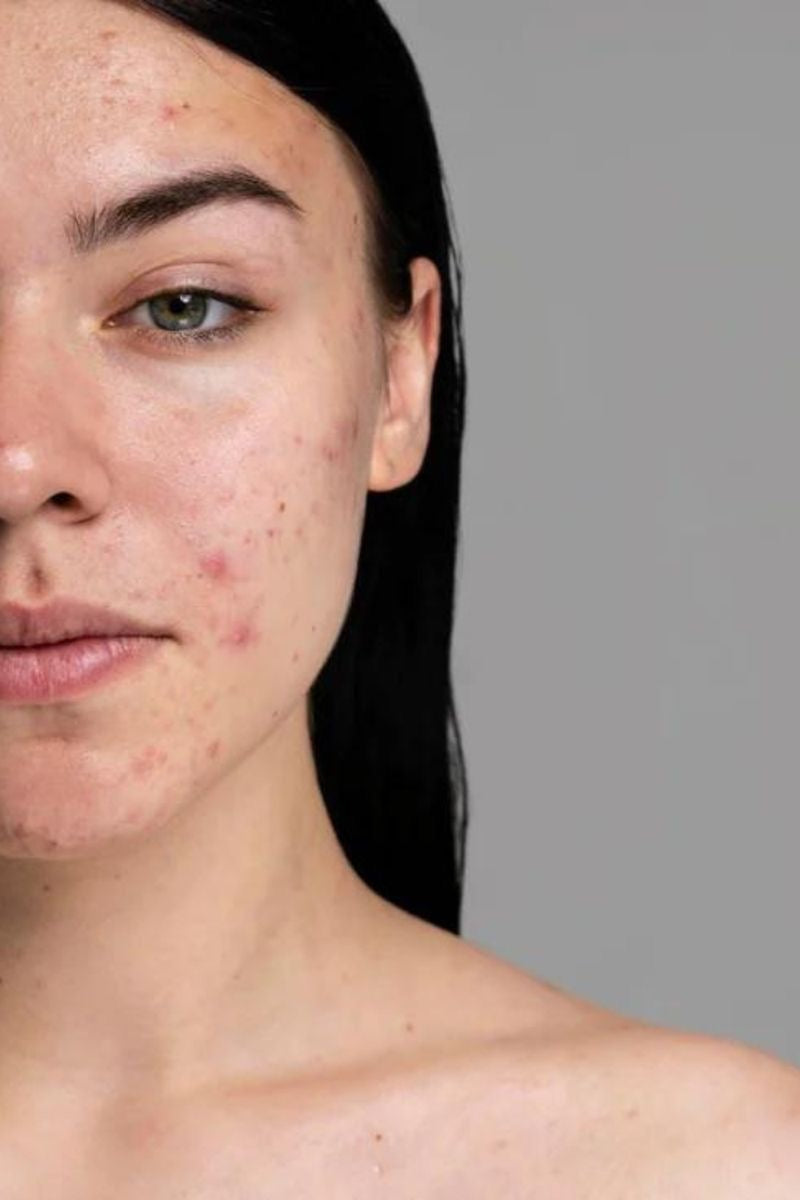 Close-up of an acne-prone woman's face with blemishes; Acne & Breakouts | Heal & balance